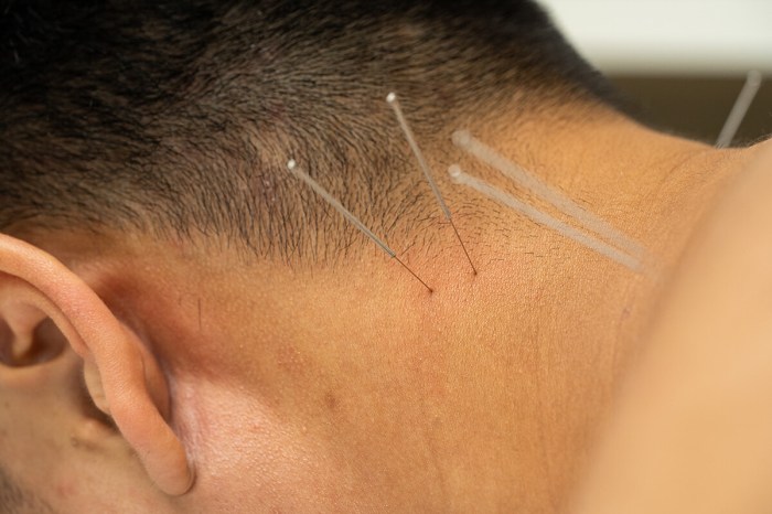 What insurance companies cover dry needling